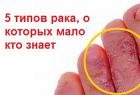 5 типов рака, о которых мало кто знает 5 типов рака, о которых мало кто знает